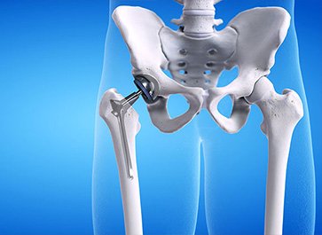 Dr. Mohit Shete Best Total Hip Replacement Surgeon in Ghatkopar, Mumbai