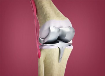 Dr. Mohit Shete Best Total Knee Replacement Surgeon in Ghatkopar, Mumbai